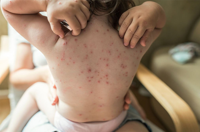 Chickenpox جدري الماء
